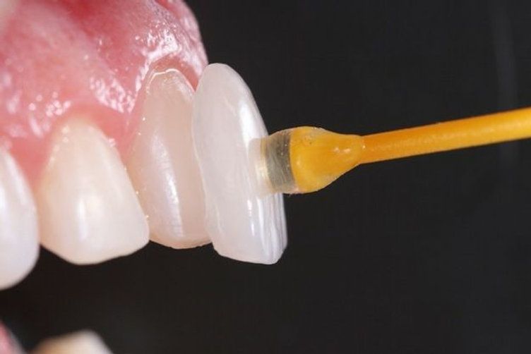 How Long Do Veneers Last, And When Should You Replace Them?