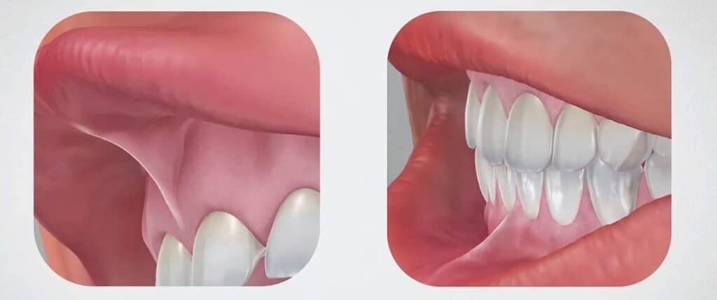 Frenectomy In Adults: Why And When It’s Recommended