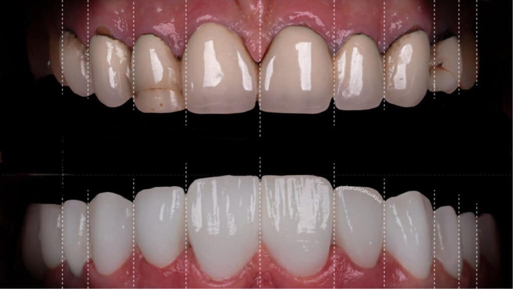 3D illustration of dental implants supporting lower dentures in transparent skull view.