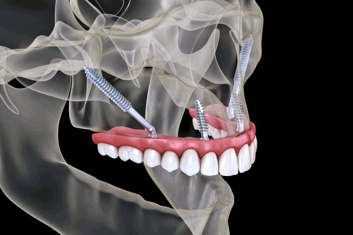 Illustrazione 3D di impianti dentali che fissano la protesi superiore in vista del cranio trasparente.