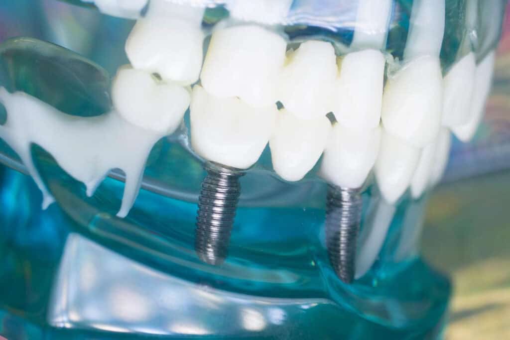 Modello di impianto dentale che mostra le radici artificiali dei denti nell'osso mascellare a scopo didattico.