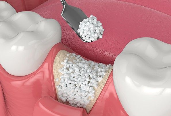 Bone Grafting In Albania: Turning “Impossible” Cases Into Implant Success Stories