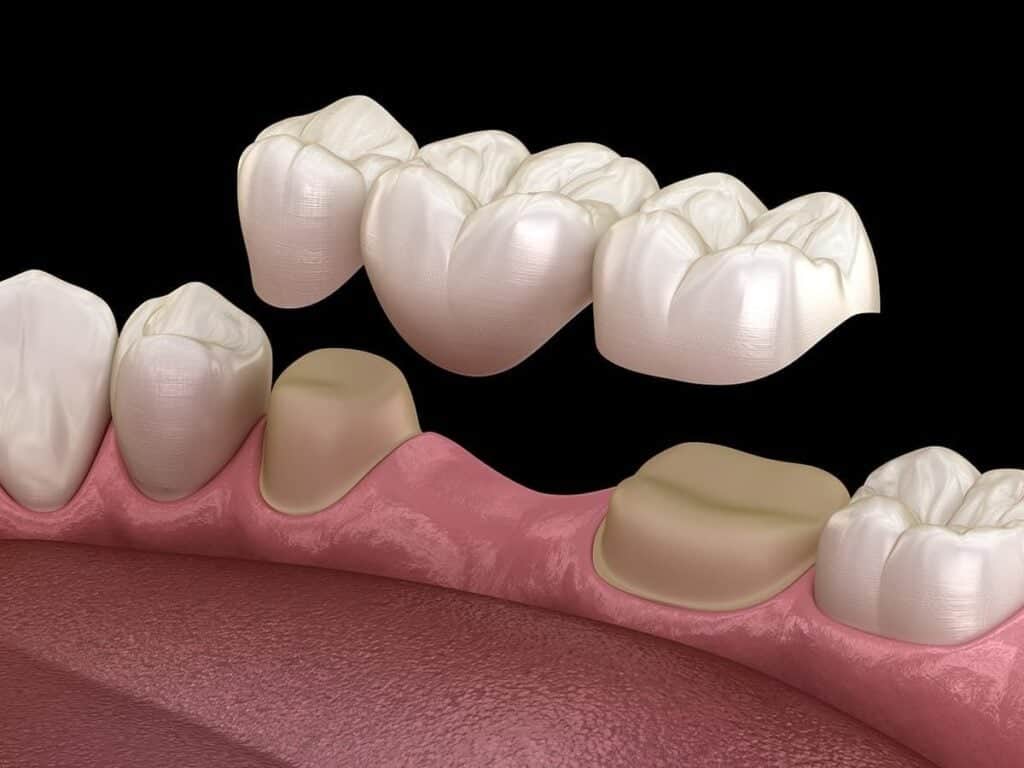 Dental Bridges Cost In Albania: Affordable Options For Missing Teeth