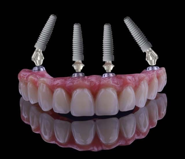 Dental implant concept showing four screws attached to a dental prosthetic arch on a black background.