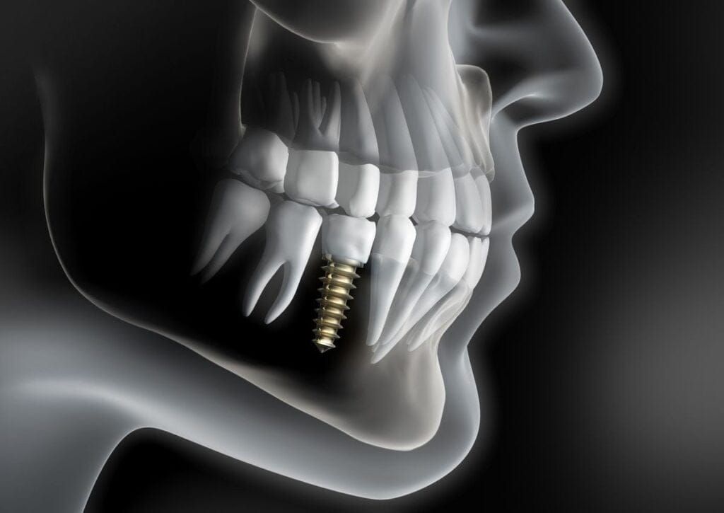 Same-Day Teeth: Immediate Loading Dental Implants Cost In Albania