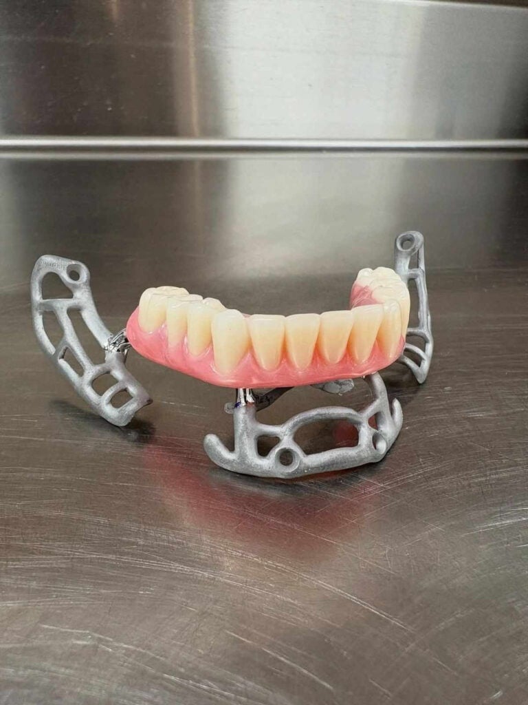 3D-printed dental implant structure on a metal background, showcasing advanced prosthetic technology.