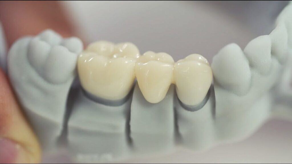 Dental bridge model showcasing realistic artificial teeth placement.