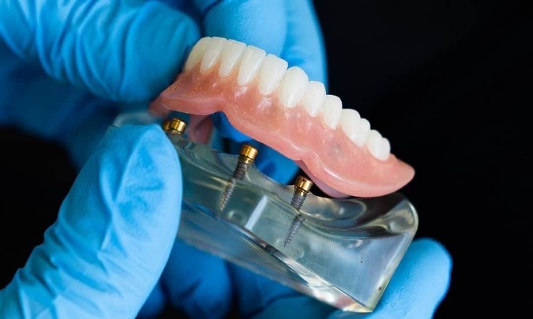 Dental professional holding a jaw model with dental implants and dentures, illustrating prosthetic dentistry.