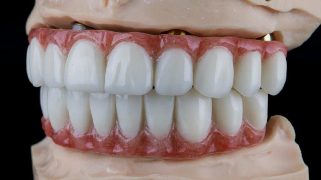 All-On-8 Implants Explained: The Most Stable Full-Arch Option 