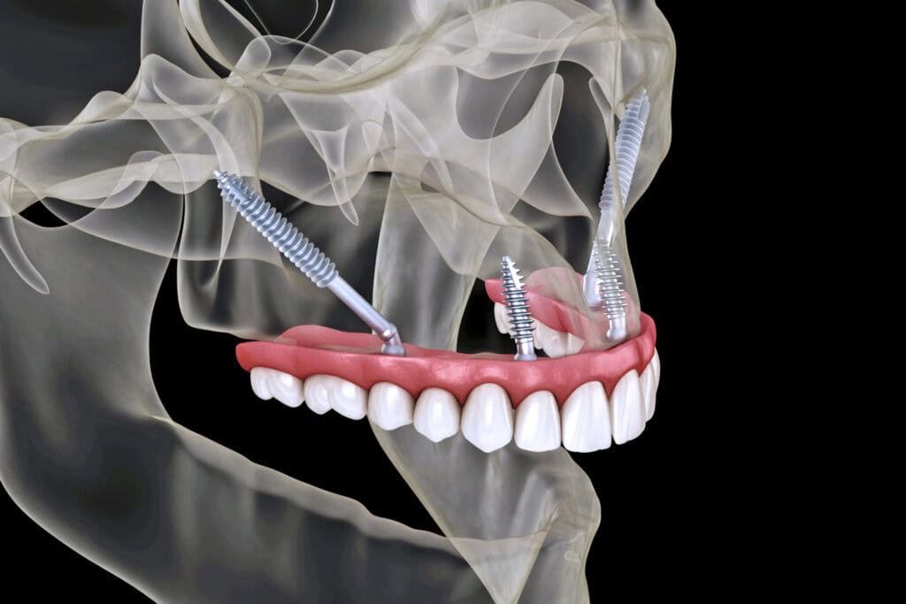 When Bone Loss Isn’t A Problem: Pterygoid Implants In Albania