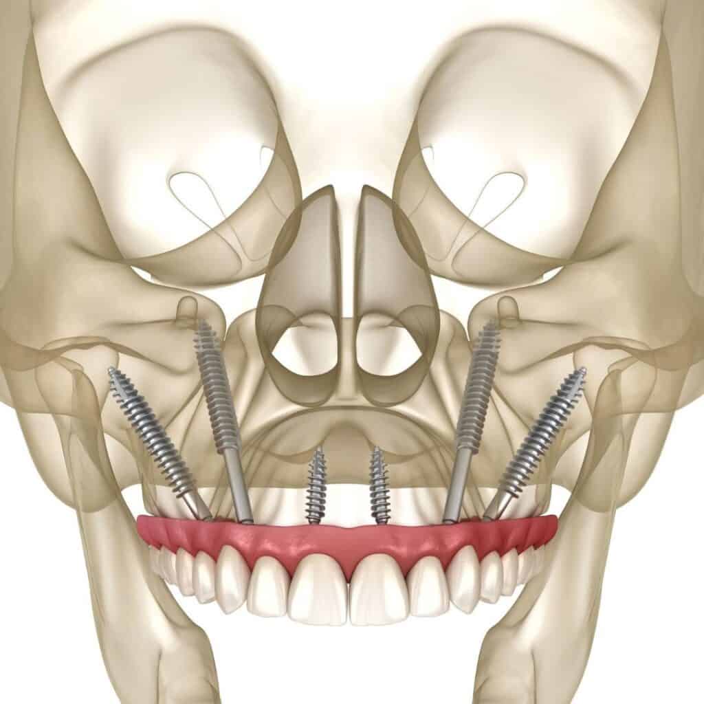Dental implant illustration showing maxilla with four angled implants for upper arch restoration.