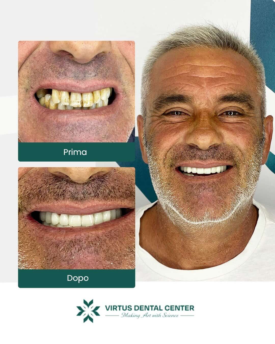 Before and after dental transformation showcasing improved smile at Virtus Dental Center.