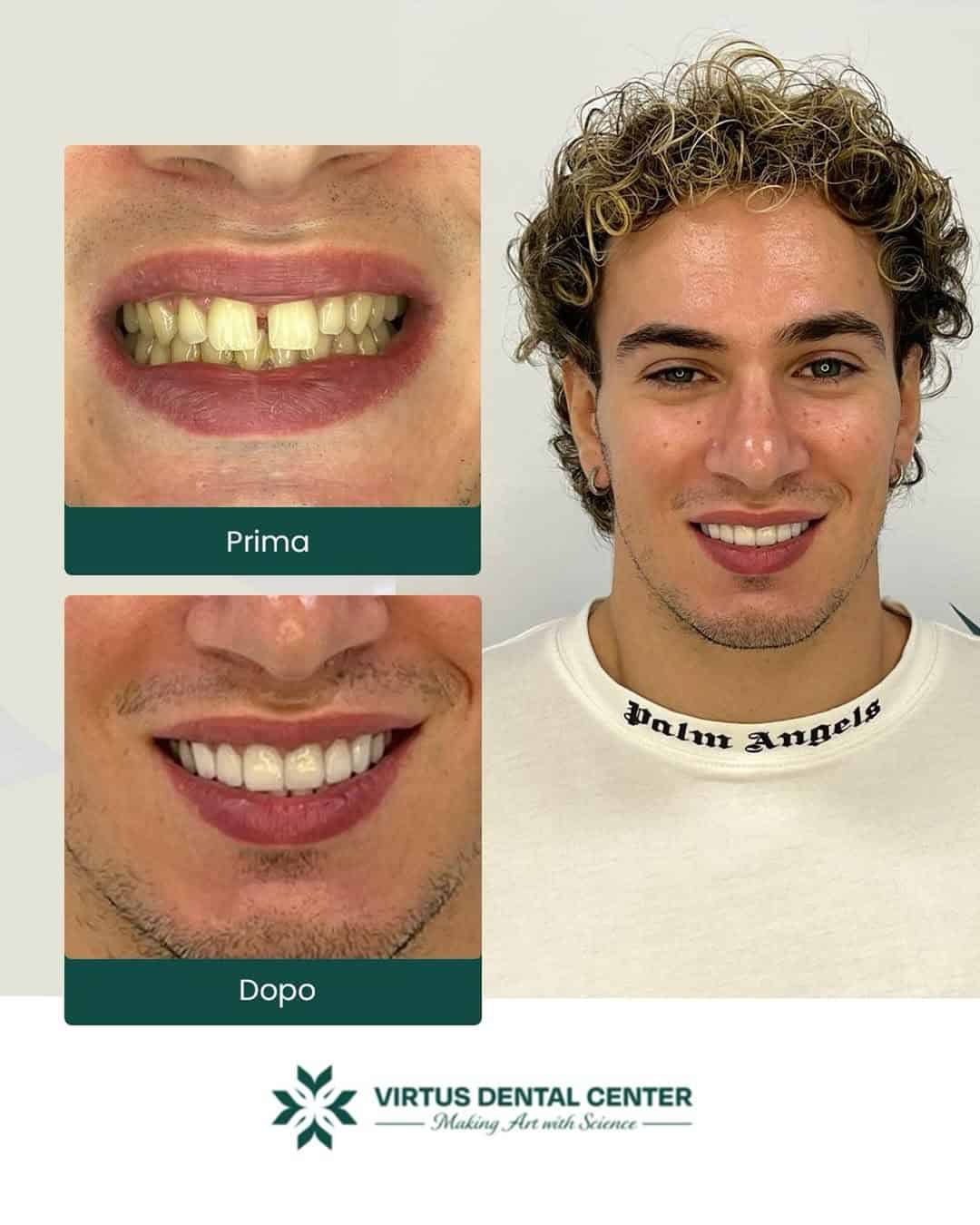 Before and after dental treatment at Virtus Dental Center showing improved smile results.