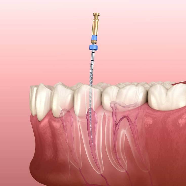 When Do You Really Need a Root Canal? The Key Symptoms to Look For