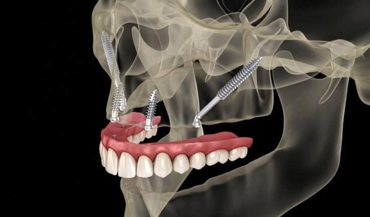 Zygomatic vs Traditional Implants: Differences, Benefits, and Patient Suitability