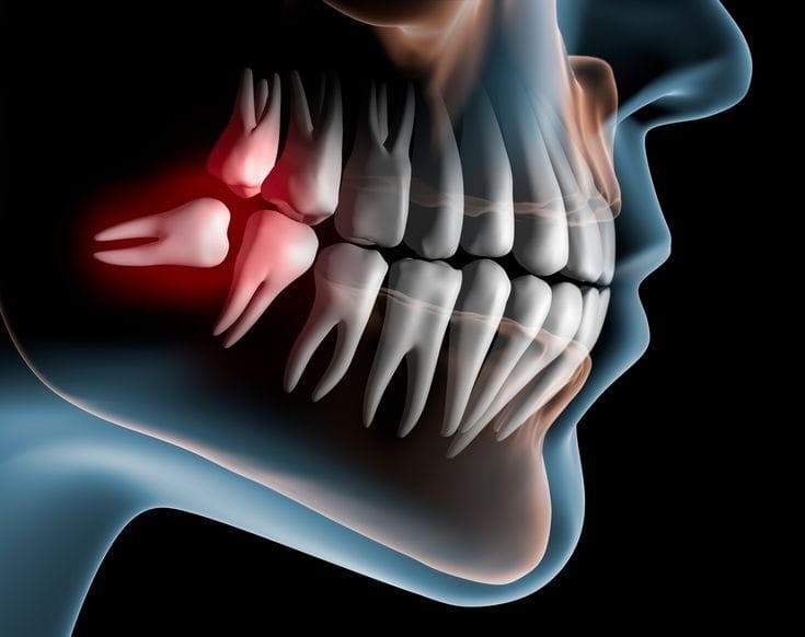 How Virtus Dental Center Handles Complicated, Impacted Wisdom Teeth
