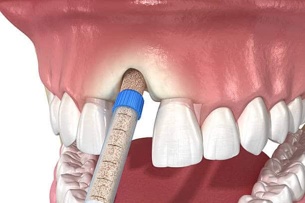 Illustrazione della procedura di innesto osseo dentale per la salute delle gengive, che mostra lo strumento che inserisce il materiale nella mascella superiore.