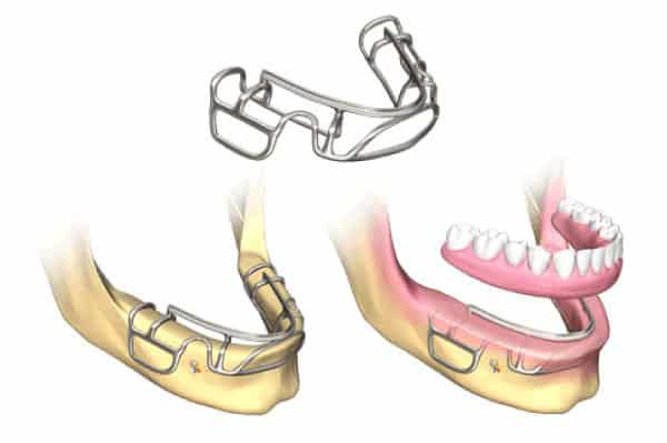 Dental wire retainer illustration showing placement on lower jaw and teeth for orthodontic treatment.