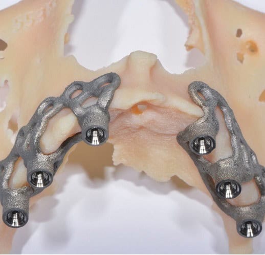 3D printed surgical implant on human skull model for craniofacial reconstruction demonstration.