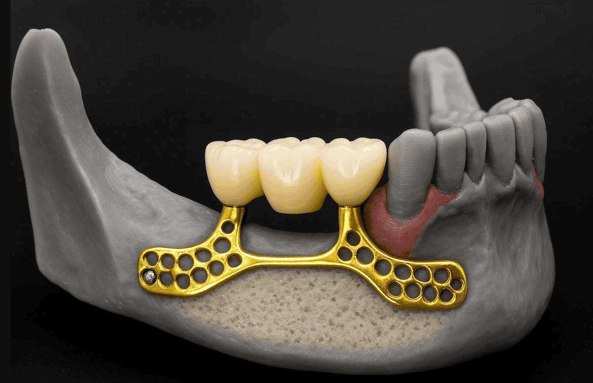 Dental implant with gold framework and artificial teeth on jaw model.