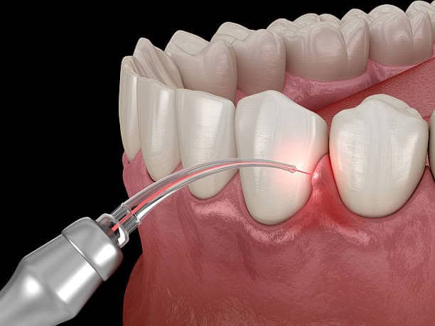 Laser Gum Treatment In Albania: Modern Care With Faster Healing