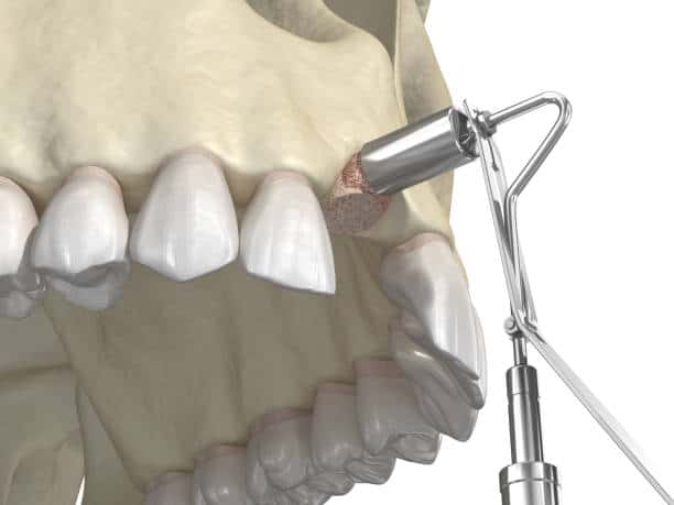 Sinus Lift Surgery For Dental Implants: Techniques And Recovery