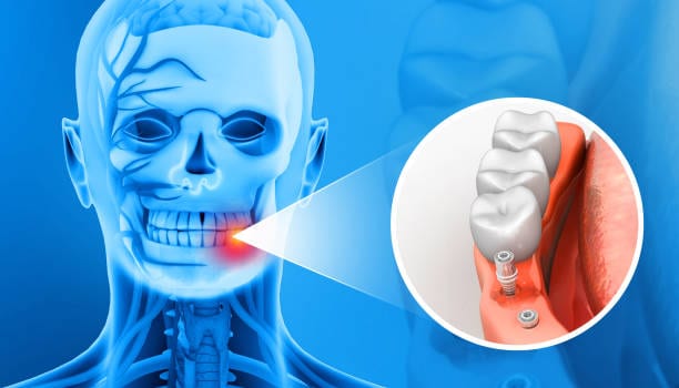 Treatment Options For Severe Jawbone Atrophy