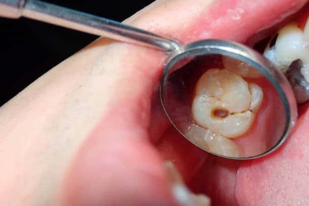 Dental exam with mirror showing tooth cavity up close.