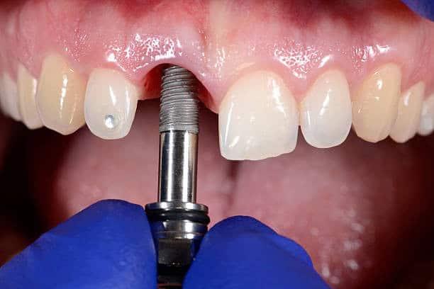 Dental implant procedure close-up, dentist with blue gloves inserting a titanium implant into patient's upper jaw, open mouth.