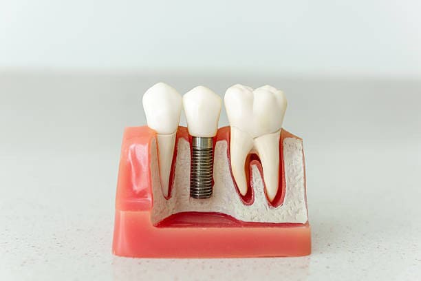 Dental implant model showing artificial tooth and roots in gum structure for educational purposes.