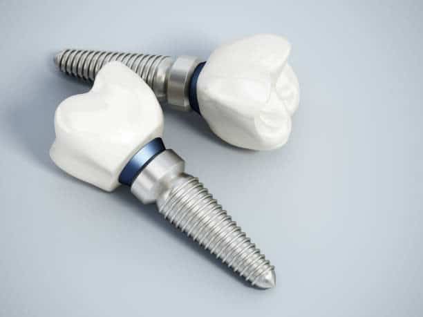 Two dental implants with ceramic crowns on a gray background, showcasing modern dental technology and innovation.