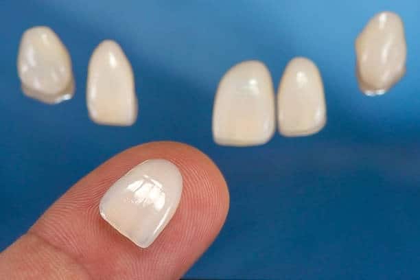 Close-up of dental veneers on a finger, highlighting their thin structure and natural appearance against a blue background.