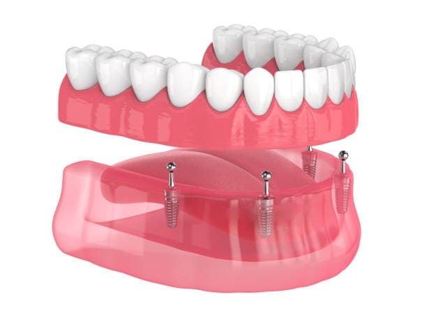 3D illustration of a dental implant-supported overdenture showcasing how it fits onto implants in the lower gum.