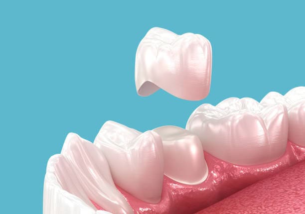 Dental crown being placed over a tooth illustration with blue background.