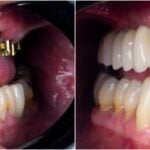 Can You Replace Several Missing Teeth Without One Implant Per Tooth?