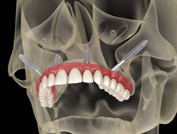 X-ray illustration of a dental implant procedure with four screws and a full-arch denture for upper jaw restoration.