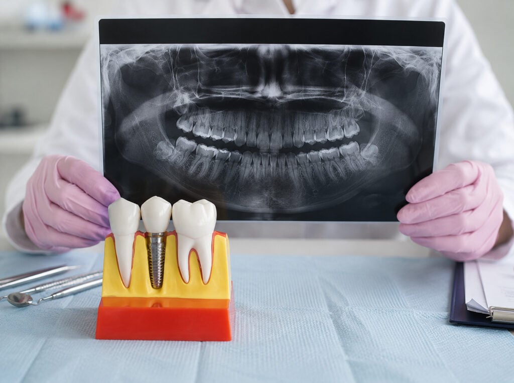 Il dentista tiene una radiografia dentale con un modello di impianto dentale sul tavolo, evidenziando le cure dentistiche e le procedure di impianto.