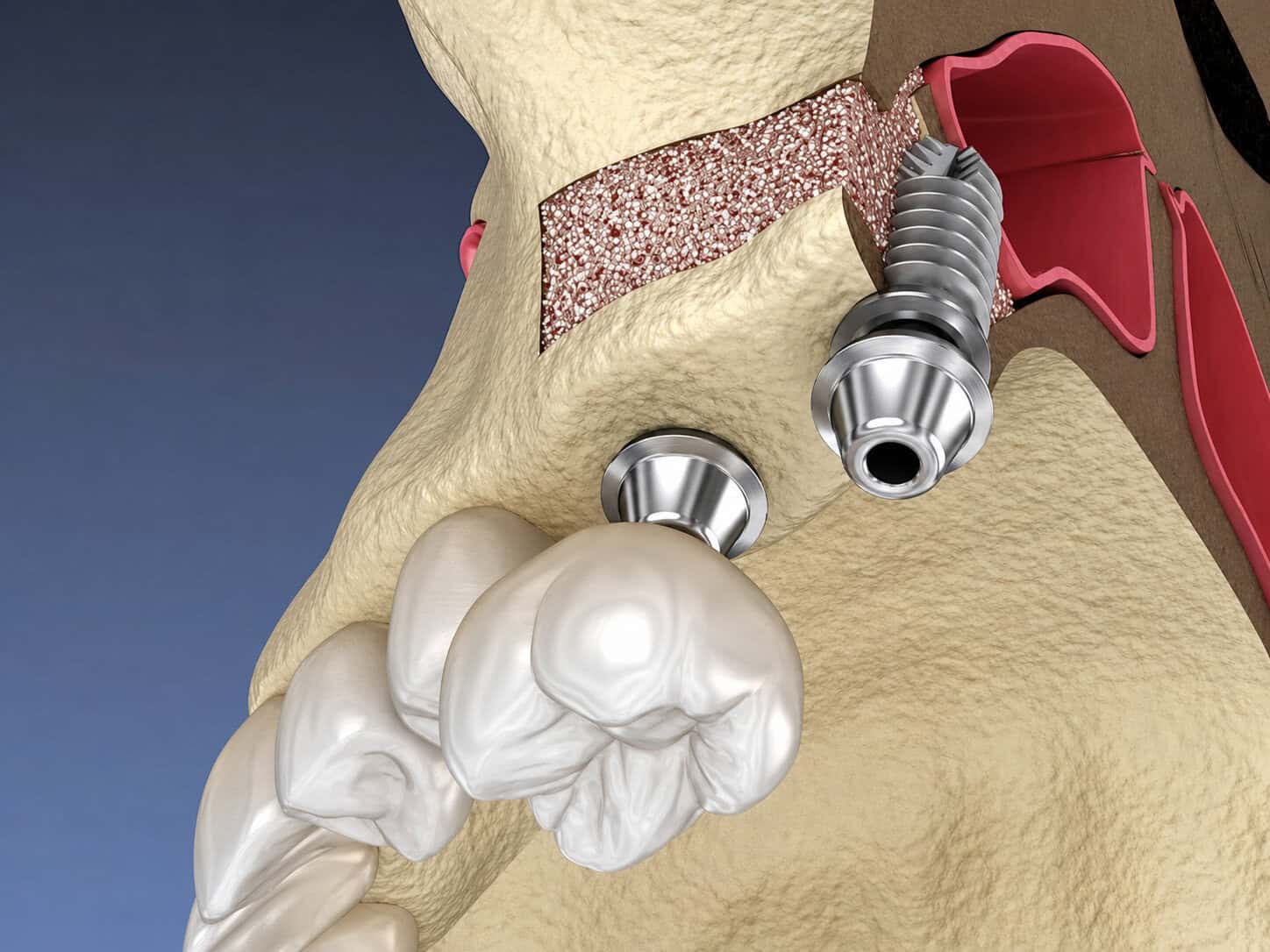 Illustration of dental implant in jawbone with sinus lift for oral surgery and tooth replacement.