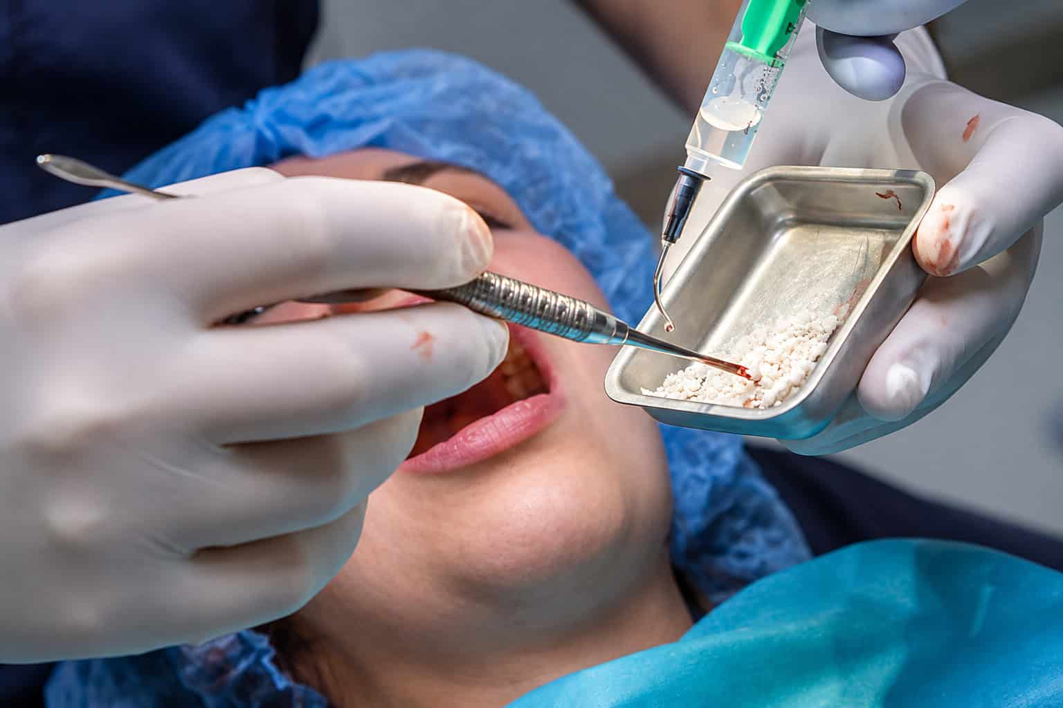 Dental surgery in progress with dentist applying bone grafting material using surgical tools.