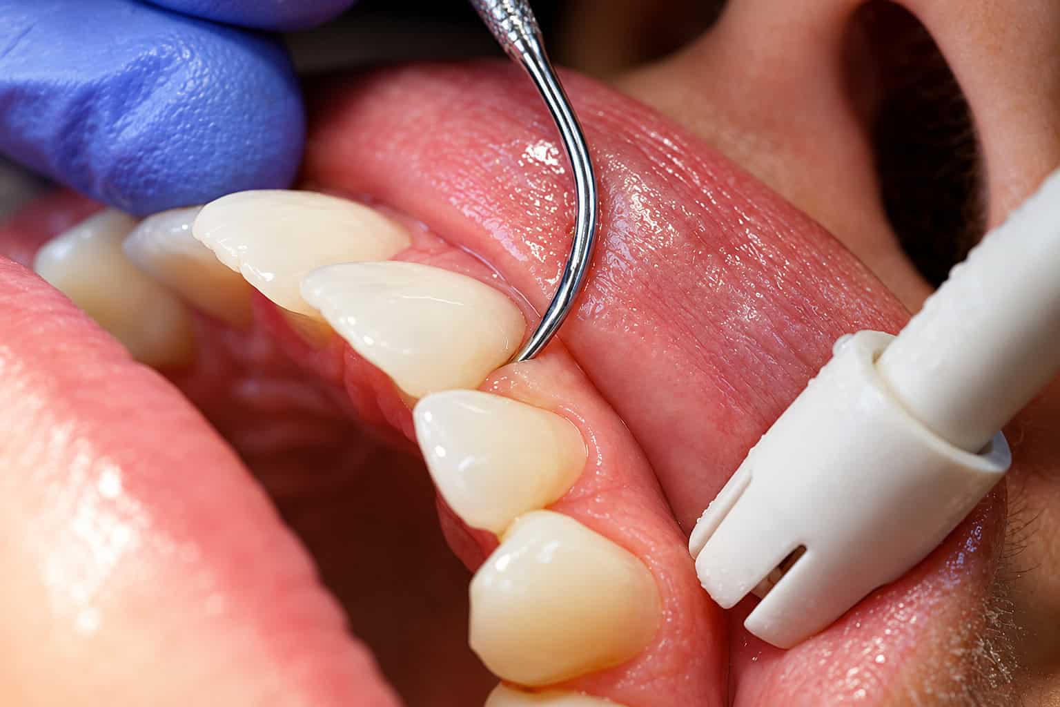Close-up of dental cleaning procedure with dental scaler on teeth and gums, enhancing oral hygiene and health.