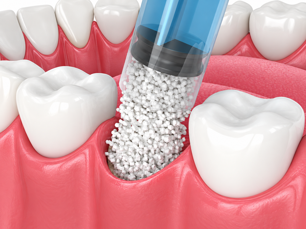 Illustration of dental bone graft surgery with gloved hands placing bone granules on the jaw under surgical lights.